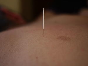 ACUPUNTURA