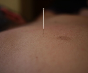 Acupuntura