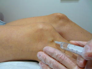 MESOTERAPIA HOMEOPÁTICA