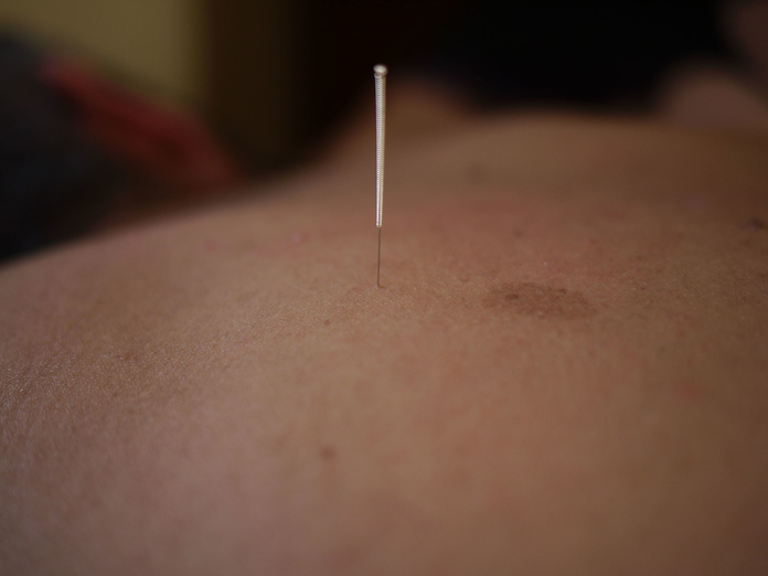 Acupuntura - Tratamientos Kinegé
